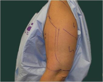 Liposuction of the arms 589893