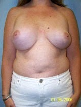 Revision Breast Surgery before 370397