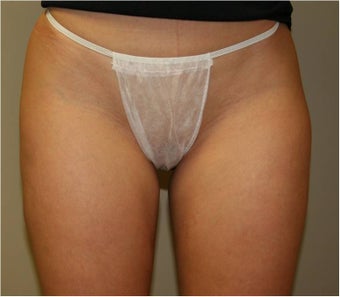 SmartLipo SaddleBags and Medial Thighs (mild) after 109408