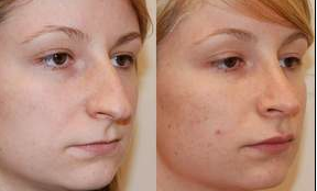 Rhinoplasty and Lip Augmentation with Silikon-1000 before 153622