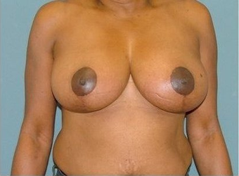 Breast Reduction after 97010