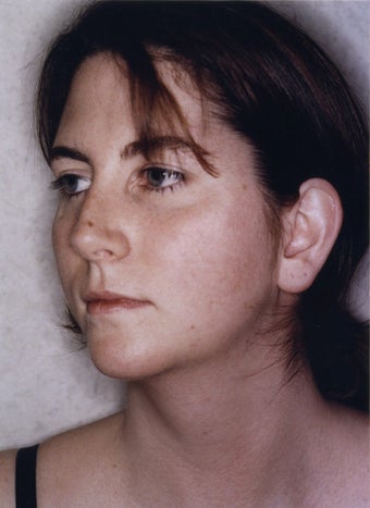 Neck Liposuction after 628887