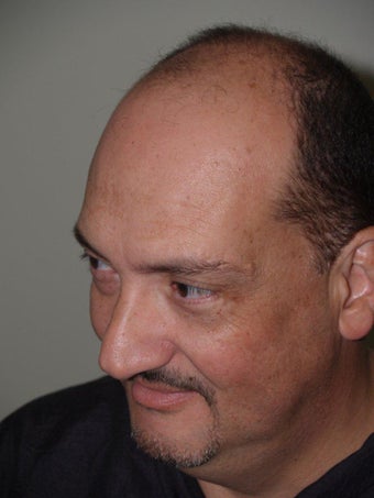Hair Transplant - 3400 grafts before 235612