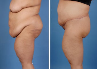 Lower Body Lift and Extended Tummy Tuck after 335991