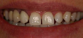 Porcelain Veneers and Crowns before 485379