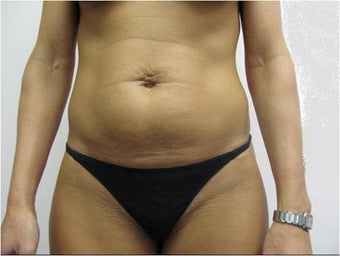Laser Liposuction and Mini Tummy Tuck before 341296