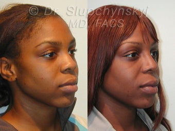 African American Rhinoplasty after 609011