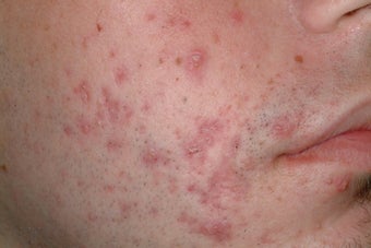Acne treatment with Accutane before 95915
