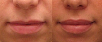 Lip Augmentation with Juvederm before 267287