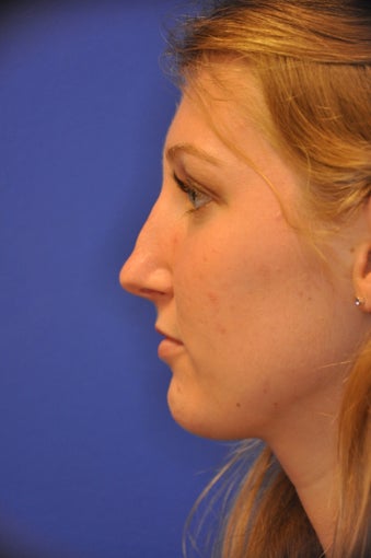 Revision Rhinoplasty before 478750