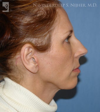 Chin Implant after 502574