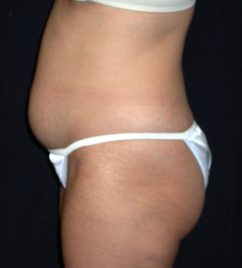 Tummy Liposuction before 229700