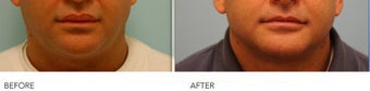 Male Upper Lip Reduction before 309222