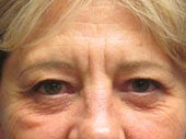 Brow Lift before 541479