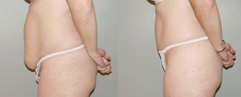 Abdominoplasty after 374957