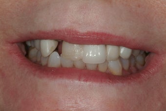 Full Mouth Reconstruction before 217470