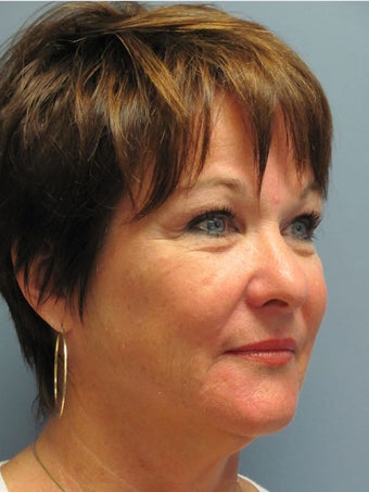 Neck Lift, Platysmaplasty 634733