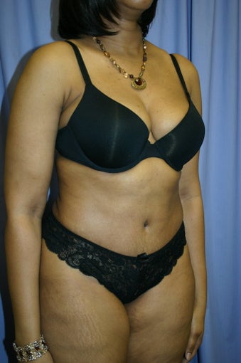 Tummy Tuck 347086