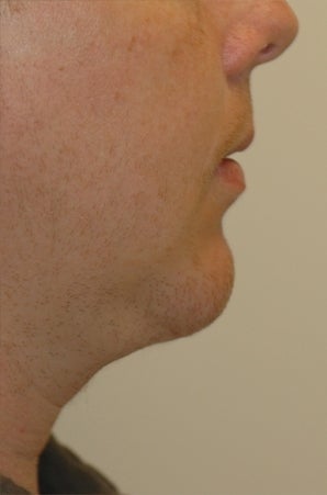 Chin augmentation, neck liposuction, and neck muscle tightening after 277313