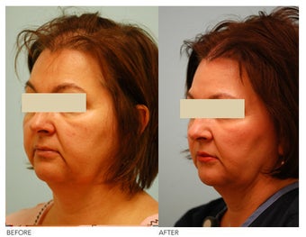 Female Hair Transplant before 133423