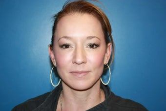 BBL and MLP Laser treatment for hyperpigmentation after 536246