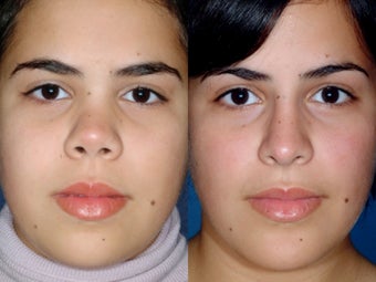 Revision rhinoplasty before 334261