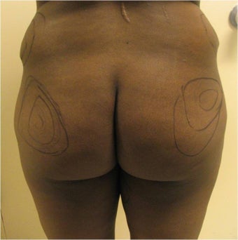 Brazilian Buttock Lift before 302922