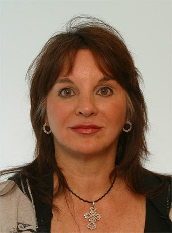 Juvederm Radiesse after 260323
