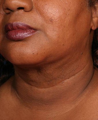 Neck liposuction with thermage after 137999