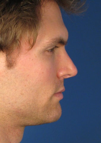 Revision Rhinoplasty 410605