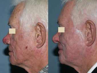 Fraxel repair in conjunction with multiple lasers before 104295