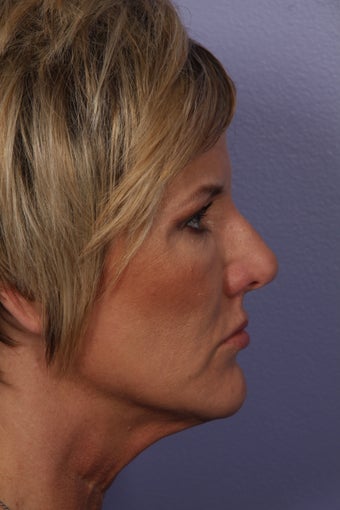 Botox after 333884