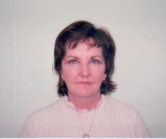 Face Lift w/ a Brow Lift and Upper & Lower Blepharoplasty after 237251