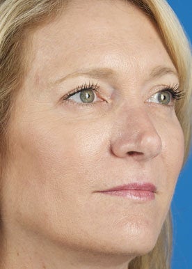 Sculptra Aesthetic after 375291