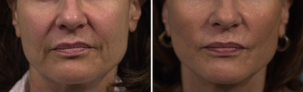 Mini Facelift before 303635