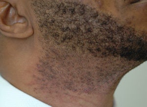 Laser Hair Removal Dark Skin before 203268