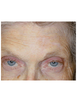 Skin cancer reconstruction after 84494