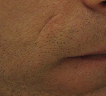 Belotero for fine etched-in lines in nasolabial folds 633104