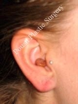 Earlobe Repair Surgery 612308