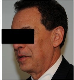 Dysport treatment for Crow's Feet before 123620