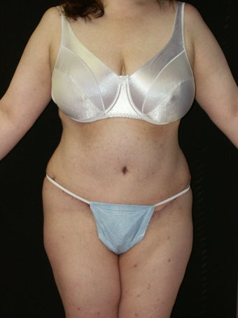 Tummy Tuck after 368682