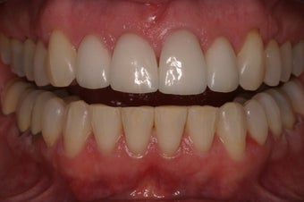 Veneers after 329683