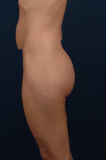 Brazilian Buttock Lift before 269886
