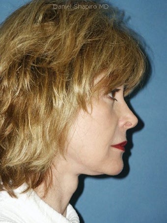 Facelift, Endoscopic Browlift, Upper and Lower Blepharoplasty, Lip Augmentation with Alloderm Grafts after 248834