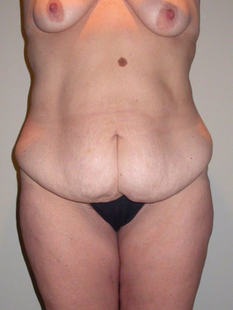 Abdominoplasty before 611782