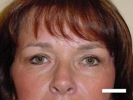Blepharoplasty after 252432