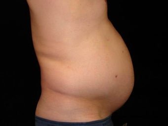 Liposuction of Abdomen, Waist, Flanks, Pecs and 6 Pack Abdominal Etching before 203544