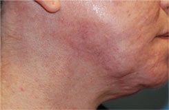 Acne Scar Treatment with Surgical Excisions and Geometric Line Closures. after 562082