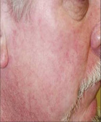 Vein treatment after 135897