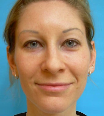 Under-Eye Filler Treatment before 567450